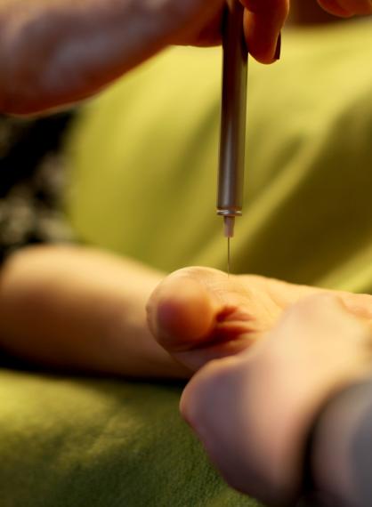 Akuounkturnål settes på hånd